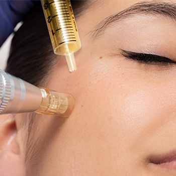 Micro Needeling  - PRO